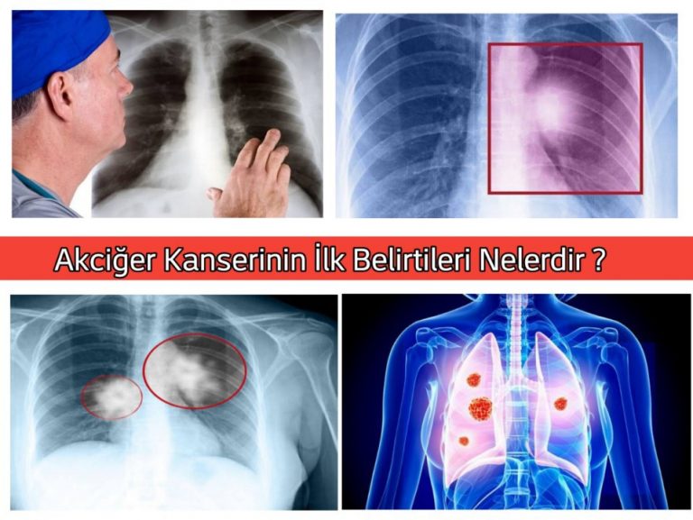 Akciğer Kanserinin İlk Belirtileri Nelerdir ?