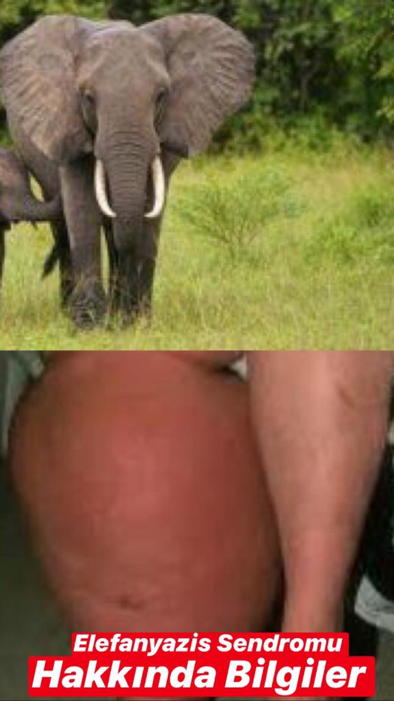 Elefantiyazis Sendromu Hakkında Bilgiler