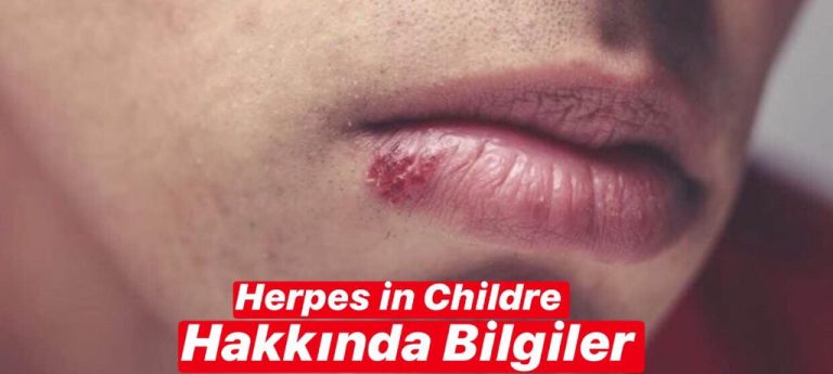 Herpes in Children Hakkında Bilgiler