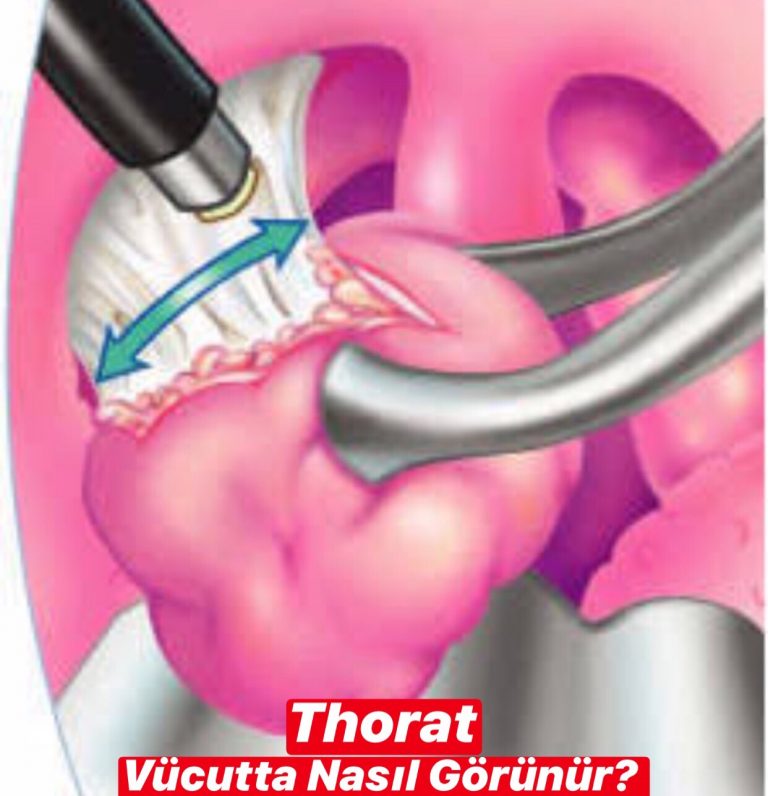 Throat İnfection Vücutta Nasıl Görünür ?