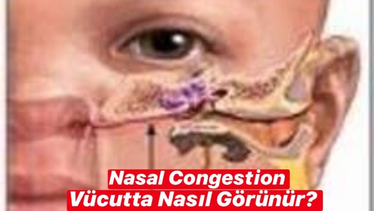 Nasal Congestion Vücutta Nasıl Görünür ?