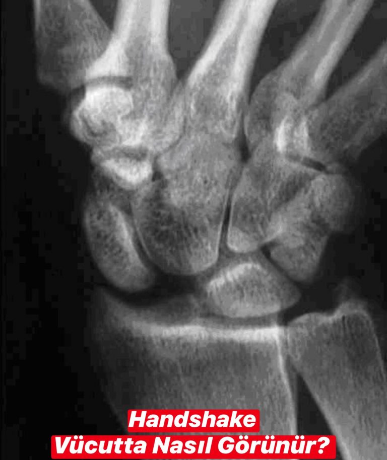 Hand Dislocations Vücutta Nasıl Görülür?