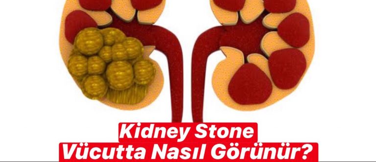 Kidney Stone Vücutta Nasıl Görünür ?