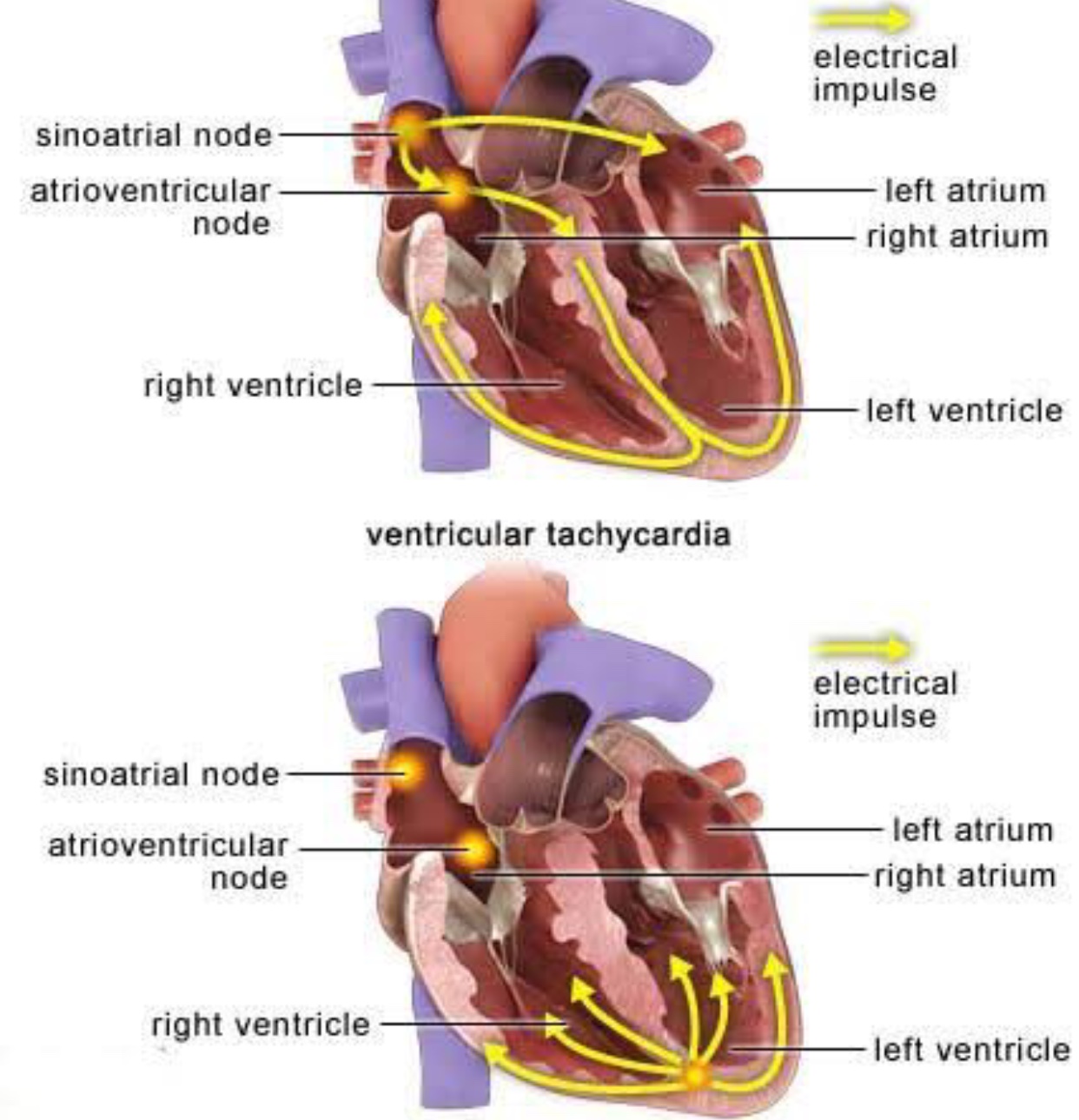 Предсердие болезни. Фибрилляция сердца. Проводящая система сердца. Образование импульса в сердце. Электрический Импульс сердца.