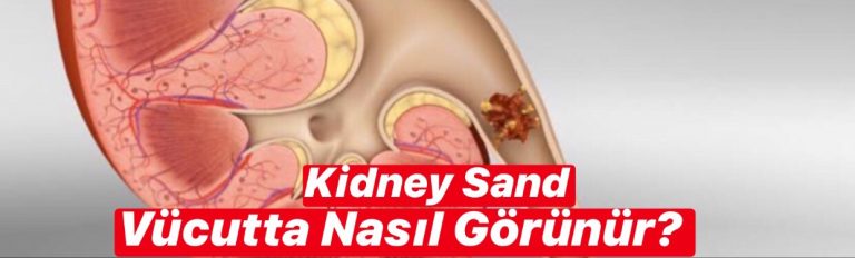 Kidney Sand Vücutta Nasıl Görünür ?