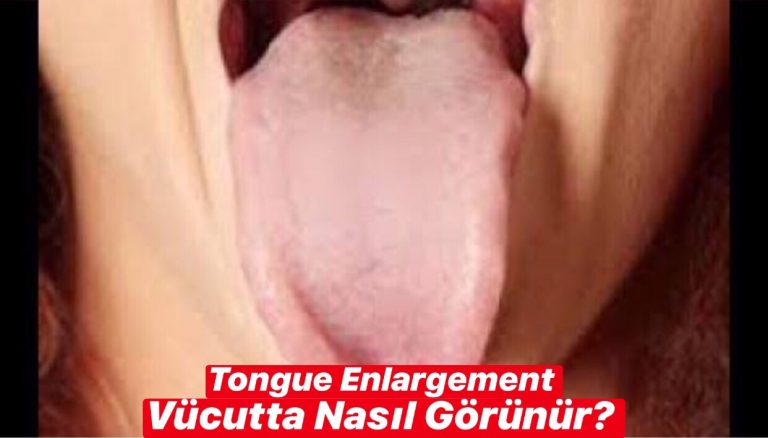 Tongue Enlargement Vücutta Nasıl Görünür ?