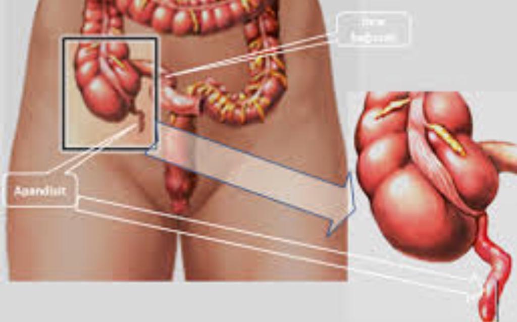 Аппендикс на теле. Анатомия человека аппендицит. Расположение аппендицита у человека.