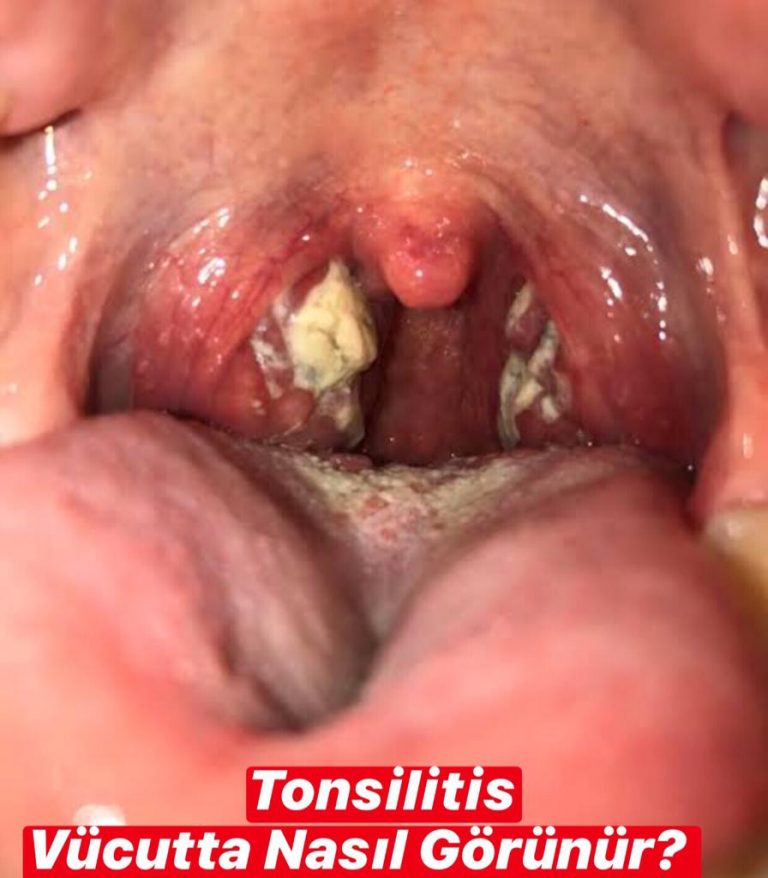 Tonsillitis Vücutta Nasıl Görünür ?