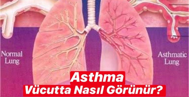 Asthma Vücudun Hangi Bölgesinde Görünür ?