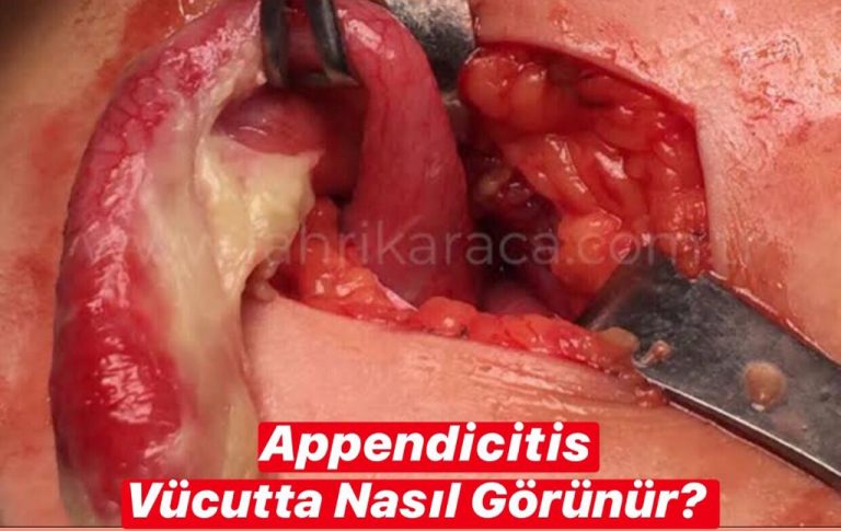 Appendicitis Vücudun Hangi Bölgesinde Görünür ?