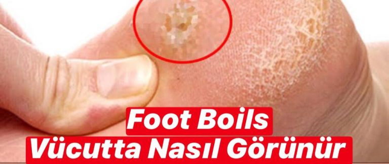 Foot Boils Vücutta Nasıl Görünür ?