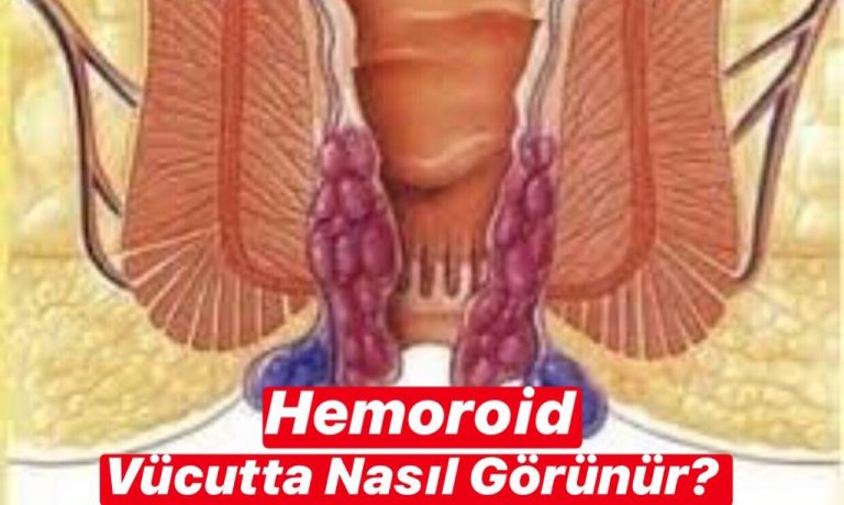 Hemoroid Vücutta Nasıl Görünür ?