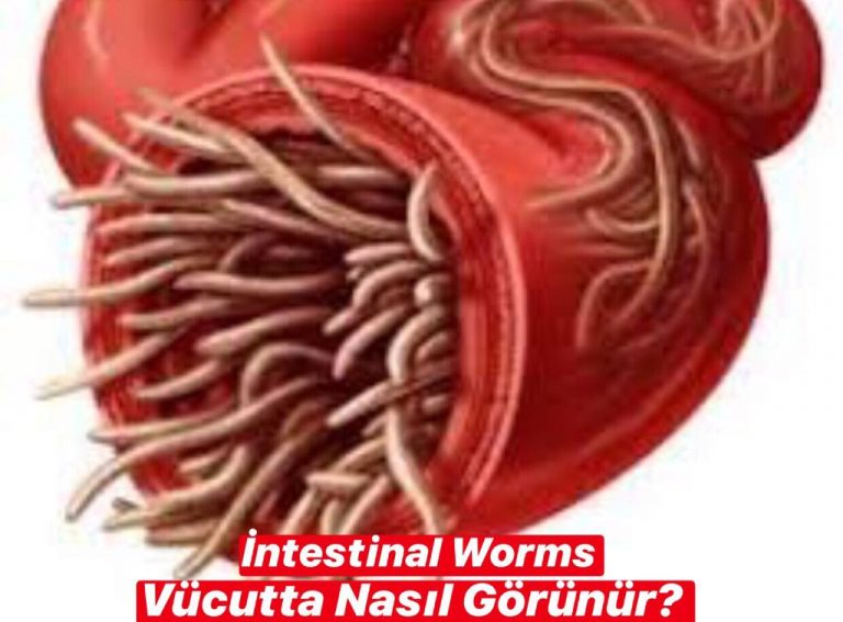İntestinal Worms Vücutta Nasıl Görünür ?