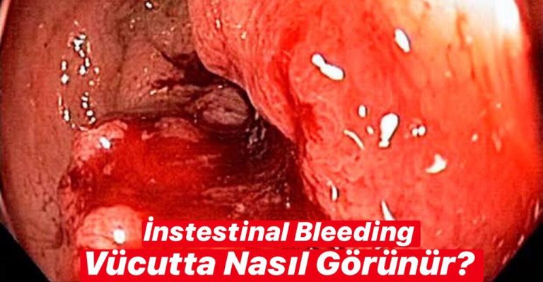 Intestinal Bleeding Vücutta Nasıl Görünür ?