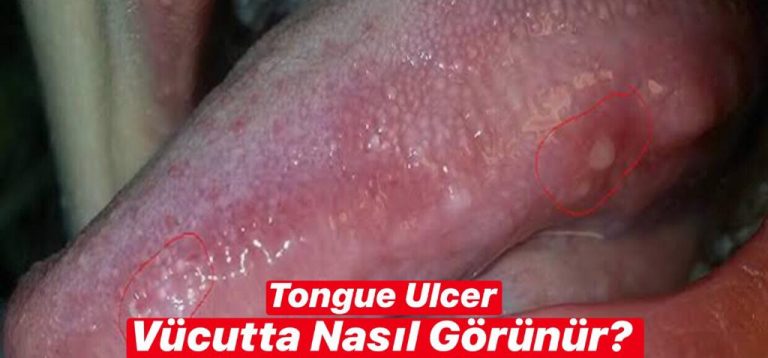 Tongue Ulcer Vücutta Nasıl Görünür ?