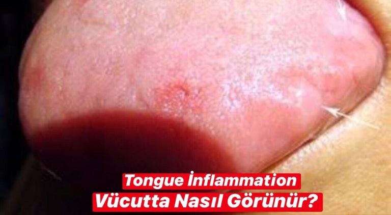 Tongue İnflammation Vücutta Nasıl Görünür ?