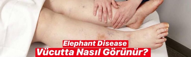 Elephant Disease Vücutta Nasıl Görünür ?