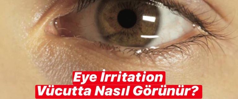 Eye İrritation Vücutta Nasıl Görünür ?