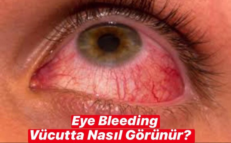 Eye Bleeding Vücutta Nasıl Görünür ?