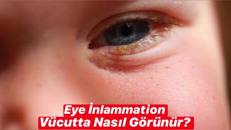 Eye İnflammation Vücutta Nasıl Görünür ?