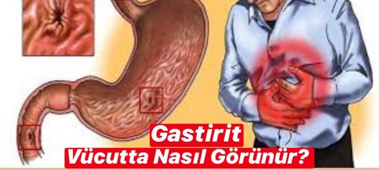 Gastrit Vücutta Nasıl Görünür ?