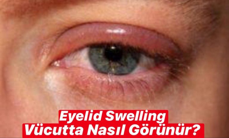 Eyelid Swelling Vücutta Nasıl Görünür ?