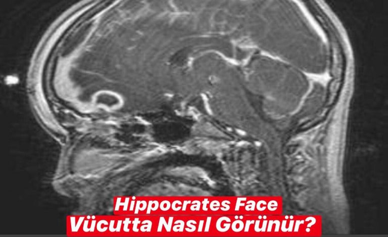 Hippocrates Face Vücutta Nasıl Görünür ?