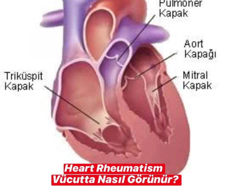 Heart Rheumatism Vücutta Nasıl Görünür ?