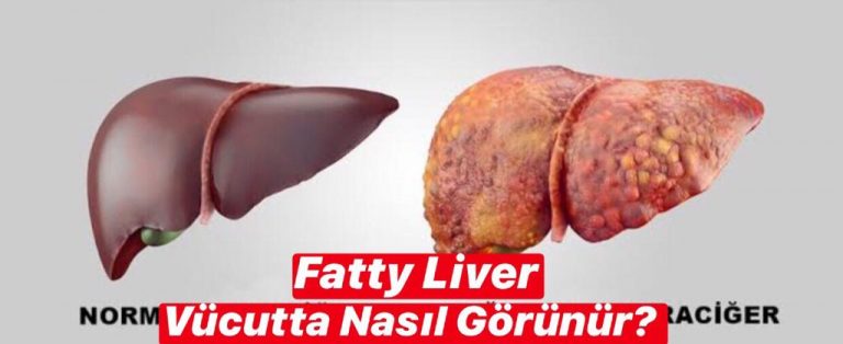 Fatty Liver Vücutta Nasıl Görünür ?