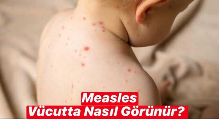 Measles Vücutta Nasıl Görünür ?