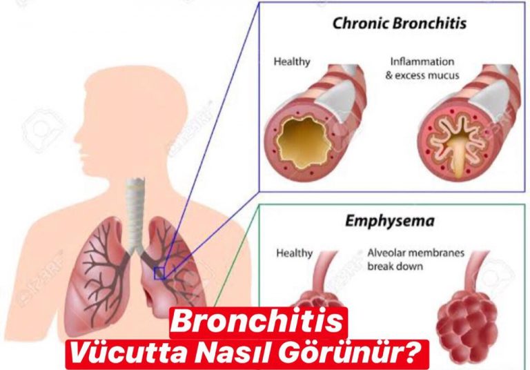 Bronchitis Vücutta Nasıl Görünür ?