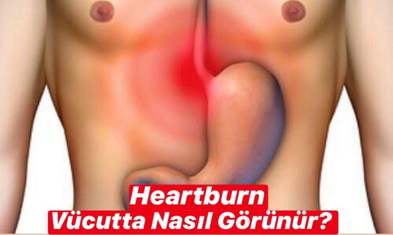 Heartburn Vücutta Nasıl Görünür ?