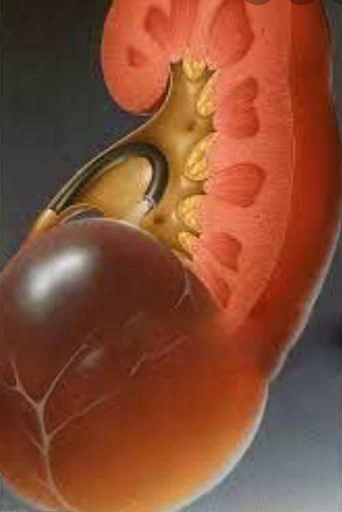 Kidney Infection Vücudun Hangi Bölgelerinde Görülür ?
